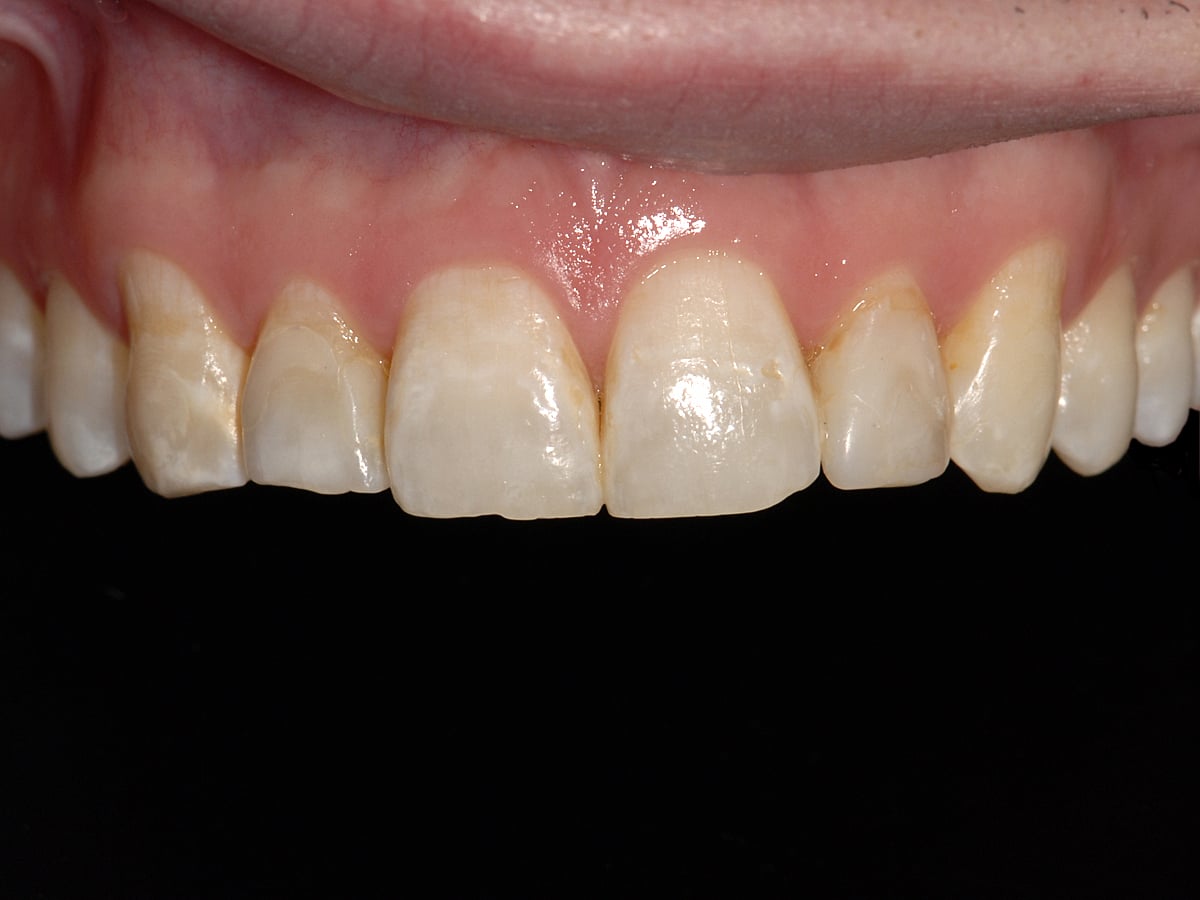 Thin Veneers Before - Vargas Rego