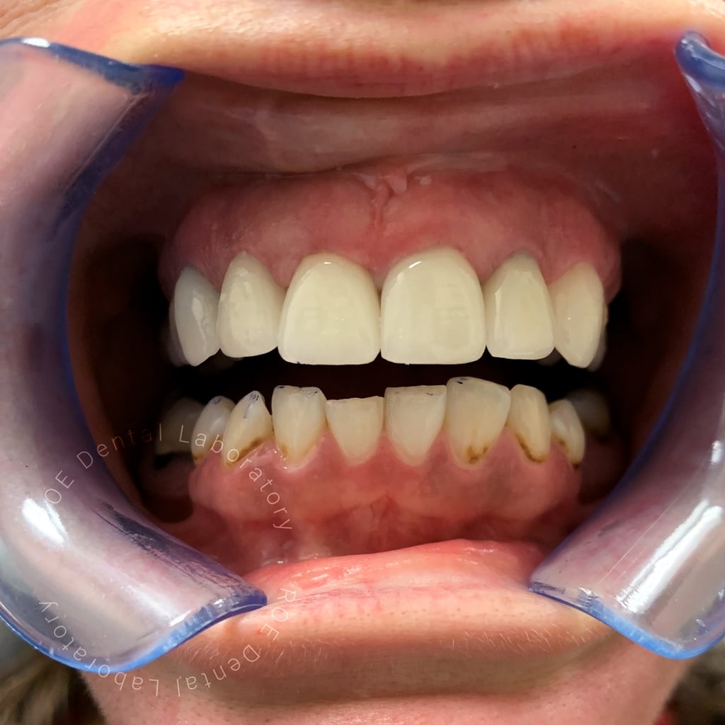 layered-veneers-AFTER