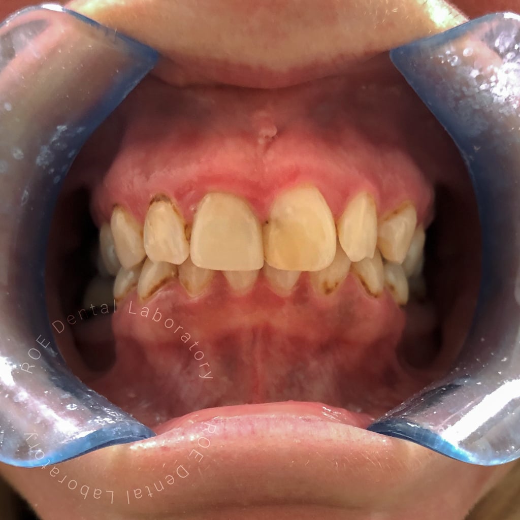 layered-veneers-BEFORE